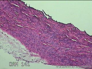 左侧卵巢囊肿组织物图7