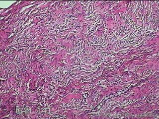 左侧卵巢囊肿组织物图15