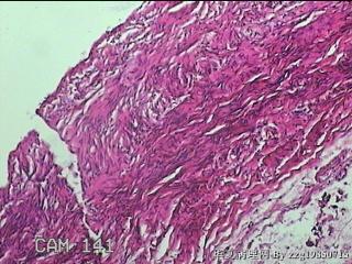 左侧卵巢囊肿组织物图12