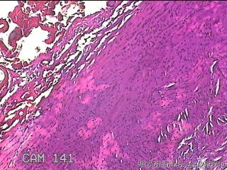 左侧卵巢囊肿组织物图28