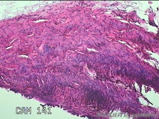 左侧卵巢囊肿组织物图4