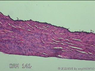 左侧卵巢囊肿组织物图8