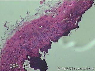左侧卵巢囊肿组织物图5