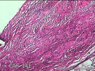 左侧卵巢囊肿组织物图13