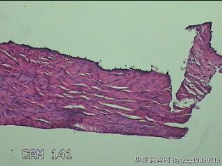 左侧卵巢囊肿组织物图9