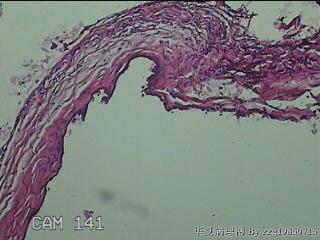 左侧卵巢囊肿组织物图33