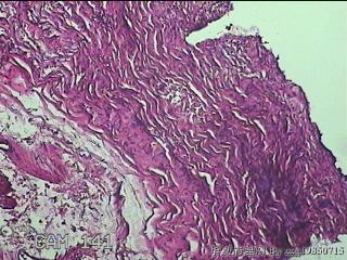 左侧卵巢囊肿组织物图21