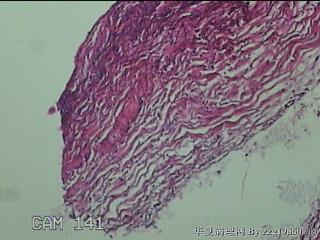 左侧卵巢囊肿组织物图11
