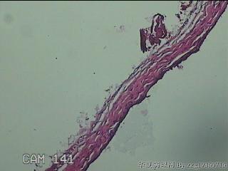 左侧卵巢囊肿组织物图31