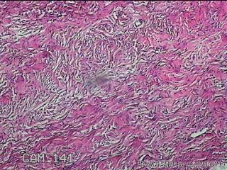 左侧卵巢囊肿组织物图16