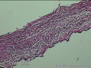 左侧卵巢囊肿组织物图35