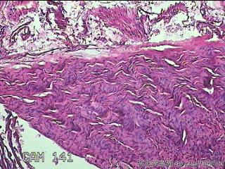 左侧卵巢囊肿组织物图23