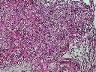 左侧卵巢囊肿组织物图19
