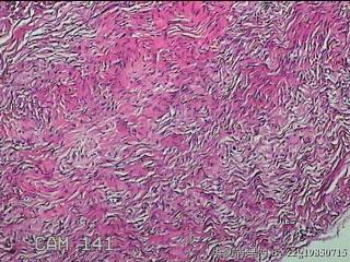 左侧卵巢囊肿组织物图17