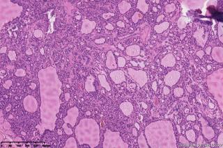 甲状腺包块图16