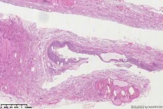 甲状腺包块图19