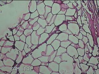 盆腔游离脂肪垂图24