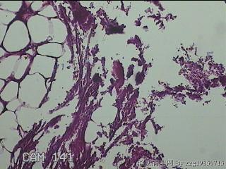 盆腔游离脂肪垂图43