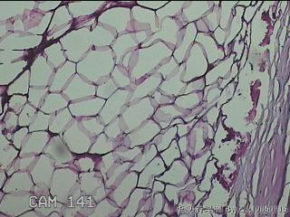 盆腔游离脂肪垂图18