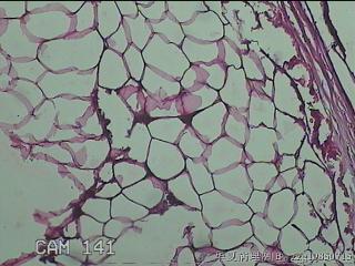 盆腔游离脂肪垂图25