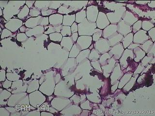 盆腔游离脂肪垂图41