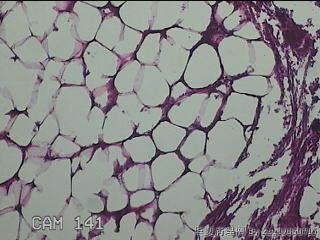 盆腔游离脂肪垂图42