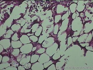 盆腔游离脂肪垂图44