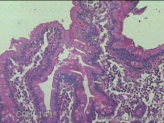 十二指肠球部粘膜图17
