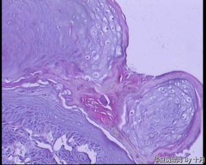 口腔软腭毛刺样赘生物活检图7