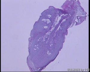 口腔软腭毛刺样赘生物活检图3