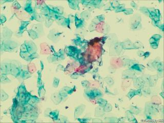 够ASC+HPV-DNA么？图11