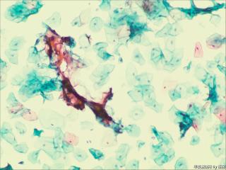 够ASC+HPV-DNA么？图11