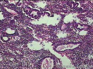 宫腔内组织图39