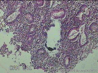 宫腔内组织图22
