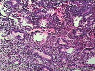 宫腔内组织图47
