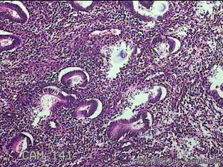 宫腔内组织图35