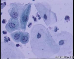55岁，宫颈液基WANG图11