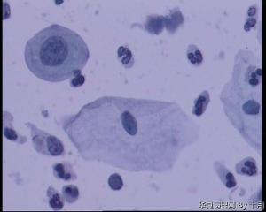 55岁，宫颈液基WANG图10