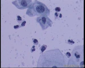 55岁，宫颈液基WANG图13