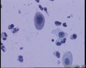 55岁，宫颈液基WANG图8