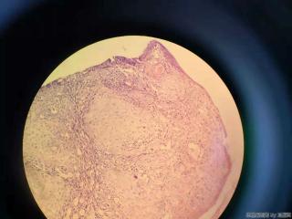 食管活检组织图3