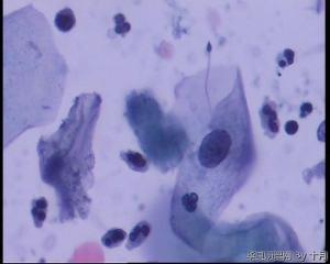 48岁，宫颈液基，仅有图3一个细胞异型明显，有意义吗？图5