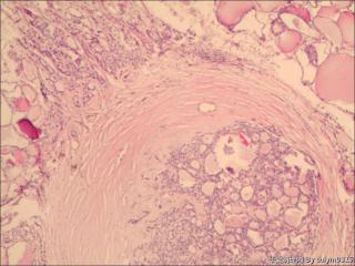 甲状腺肿物图1