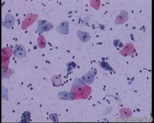 48岁，宫颈液基，仅有图3一个细胞异型明显，有意义吗？图2