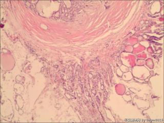 甲状腺肿物图3
