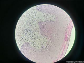 口腔赘生物，拜托老师给个诊断方向吧图6