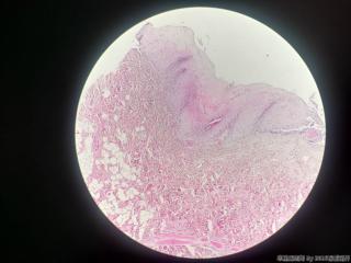 口腔赘生物，拜托老师给个诊断方向吧图3