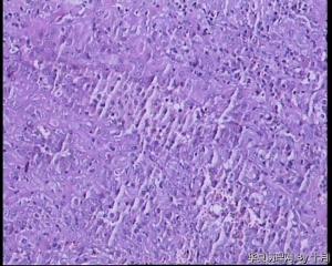 22岁，甲状腺囊性肿物，结甲囊性变？图16