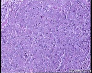 22岁，甲状腺囊性肿物，结甲囊性变？图15