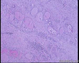 22岁，甲状腺囊性肿物，结甲囊性变？图3